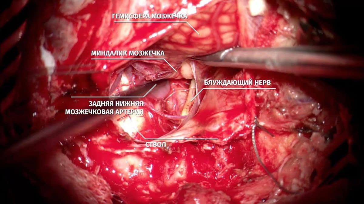 Захворювання судин головного мозку та шиї 3 фото Мікрохірургічне кліпування херсон