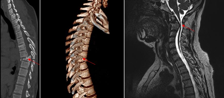 Струс і забій спинного мозку лікування у херсоні