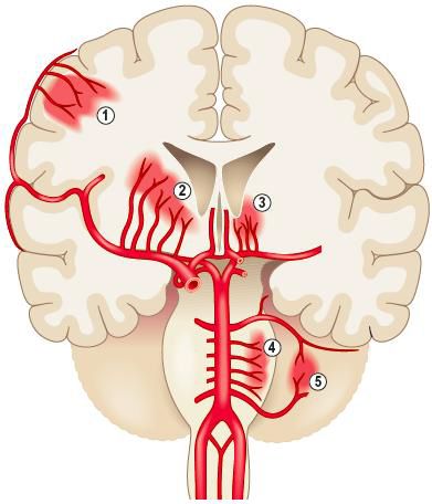 Судинні мальформації ЦНС Судинні мальформації ЦНС