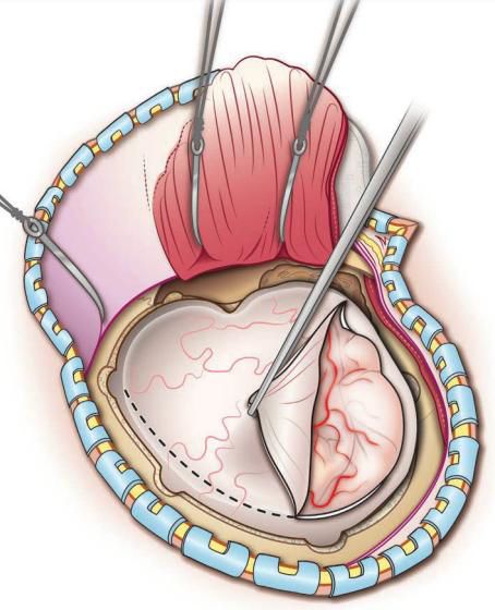 Судинні мальформації ЦНС Судинні мальформації ЦНС