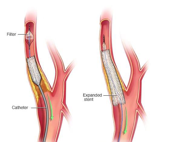 Дегенеративно-дистрофічні захворювання хребта (ДДЗХ) Дегенеративно-дистрофічні захворювання хребта (ДДЗХ)