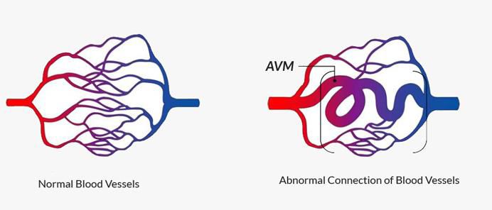 Судинні мальформації ЦНС 3 фото Судинні мальформації ЦНС 2 Тернопіль