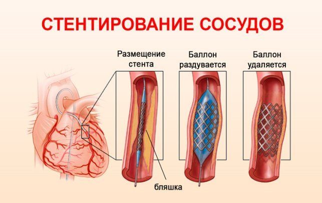 Захворювання судин головного мозку та шиї 1 фото Стентування сонних артерій