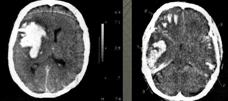 Інфекційні ураження головного і спинного мозку 2 фото Інфекційні ураження головного і спинного мозку 1 Тернопіль