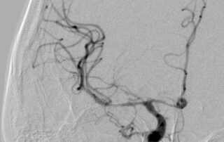 Інноваційне лікування аневризми: емболізація судин головного мозку Інноваційне лікування аневризми: емболізація судин головного мозку