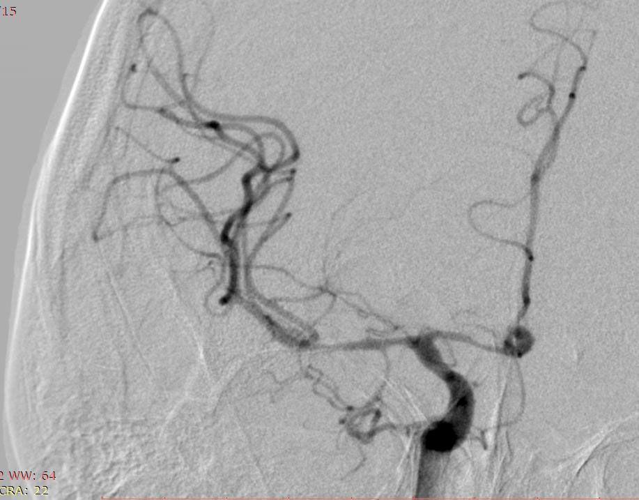 Інноваційне лікування аневризми: емболізація судин головного мозку 3 Тернопіль