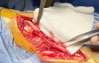 Складна пластика нерва: інновації у відновленні функцій Складна пластика нерва: інновації у відновленні функцій