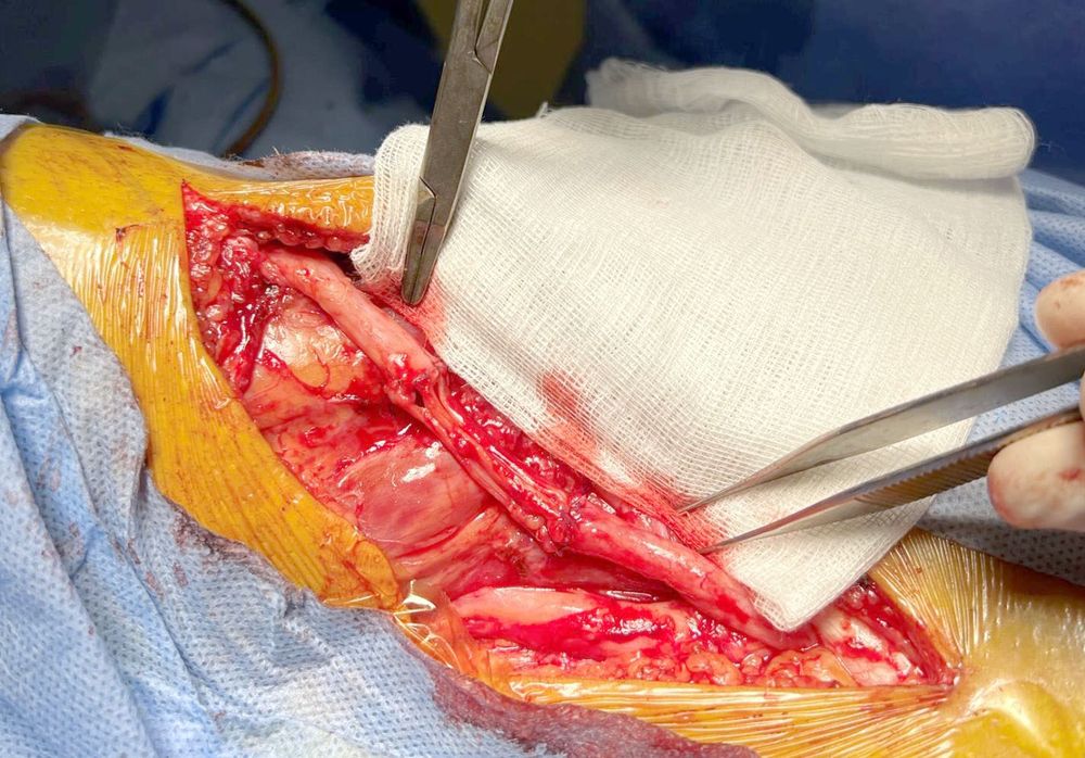 Складна пластика нерва: інновації у відновленні функцій 3 Тернопіль