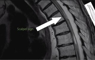 Хірургія арахноїдальної павутини Хірургія арахноїдальної павутини