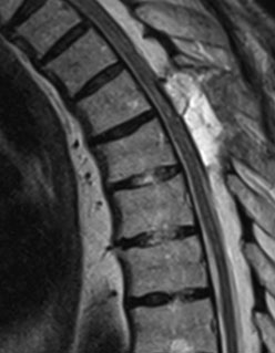 Хірургія арахноїдальної павутини 6 фото Хірургія арахноїдальної павутини 5 Тернопіль