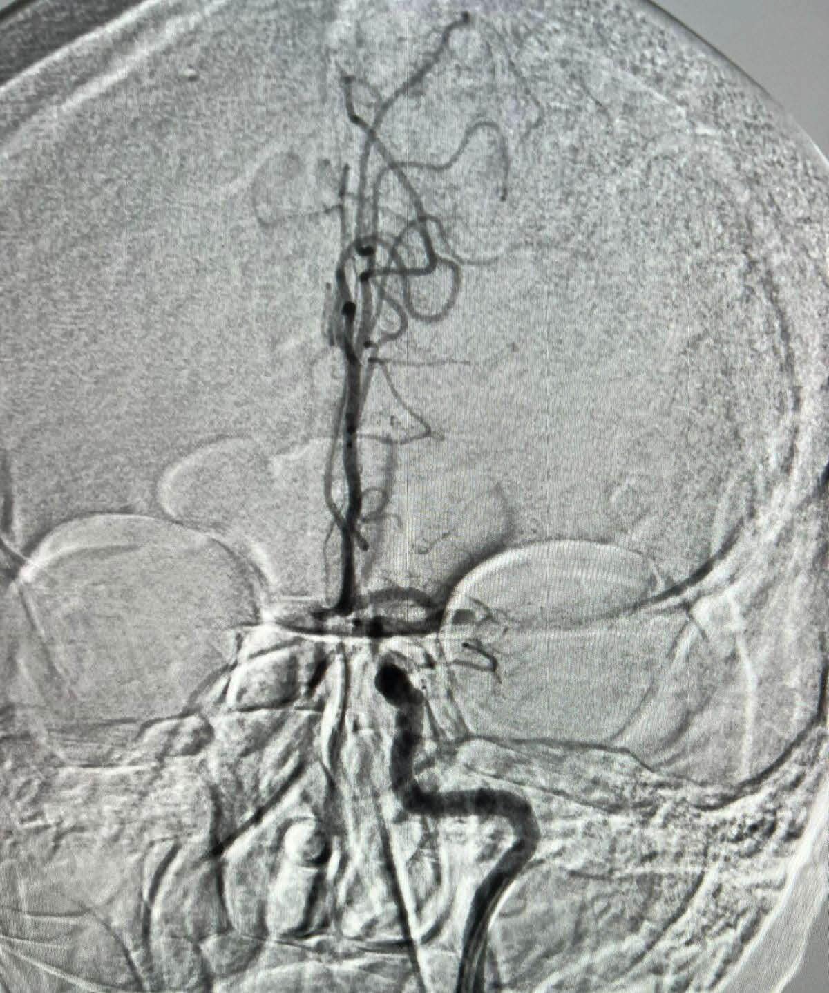 Thrombectomy-1 Інсульт: нова надія на порятунок завдяки тромбектомії 3 Тернопіль