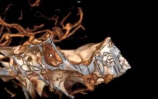 6 аневризм у одної людини 6 аневризм у одної людини