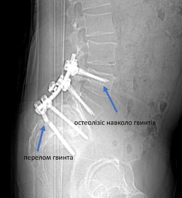 Реконструкція та рестабілізація хребта у нашого воїна 5 фото Реконструкція та рестабілізація хребта у нашого воїна 4 Тернопіль