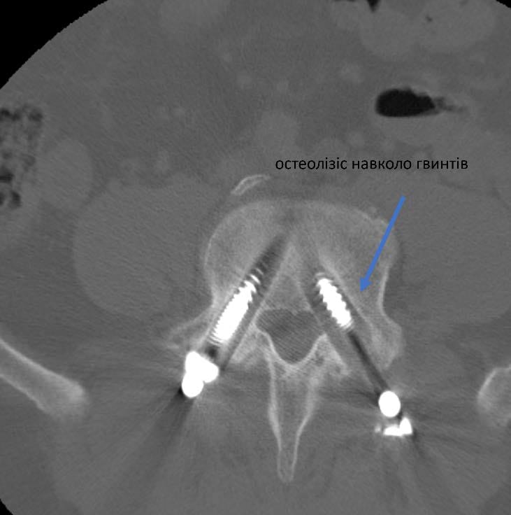Реконструкція та рестабілізація хребта у нашого воїна 7 фото Реконструкція та рестабілізація хребта у нашого воїна 6 Тернопіль