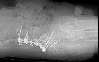 Реконструкція та рестабілізація хребта у нашого воїна Реконструкція та рестабілізація хребта у нашого воїна