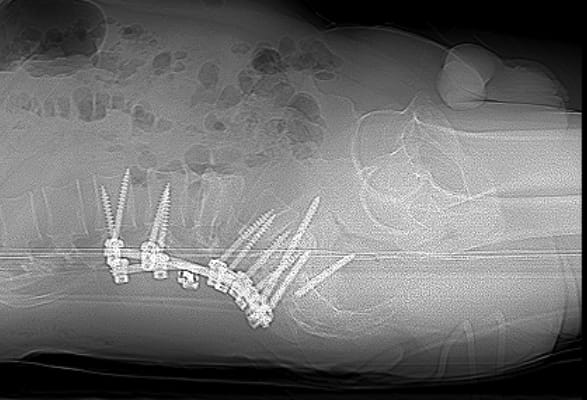 Реконструкція_хребта_у_військового-3 Реконструкція та рестабілізація хребта у нашого воїна 3 Тернопіль
