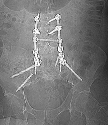Реконструкція та рестабілізація хребта у нашого воїна 11 фото Реконструкція та рестабілізація хребта у нашого воїна 10 Тернопіль