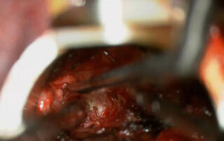 Складний випадок: як ми провели унікальну операцію для пацієнтки з пересадженою ниркою Складний випадок: як ми провели унікальну операцію для пацієнтки з пересадженою ниркою