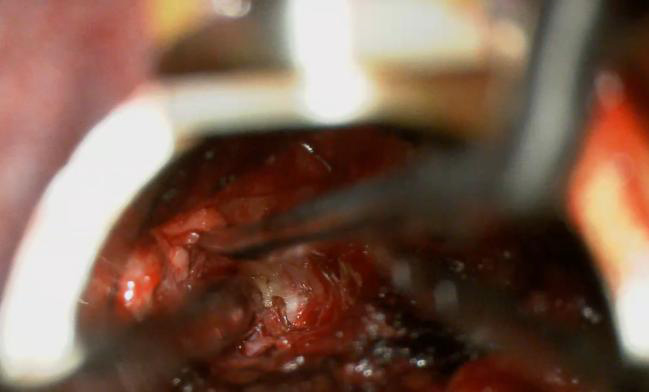 Складний випадок: як ми провели унікальну операцію для пацієнтки з пересадженою ниркою 3 Тернопіль