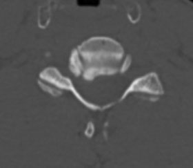 Чи обов’язково у хребет ставити метал? 4 фото Чи обов’язково у хребет ставити метал? 3 Тернопіль