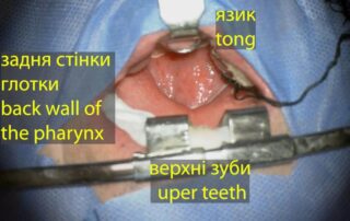 Складний випадок нагноєння хребта Складний випадок нагноєння хребта