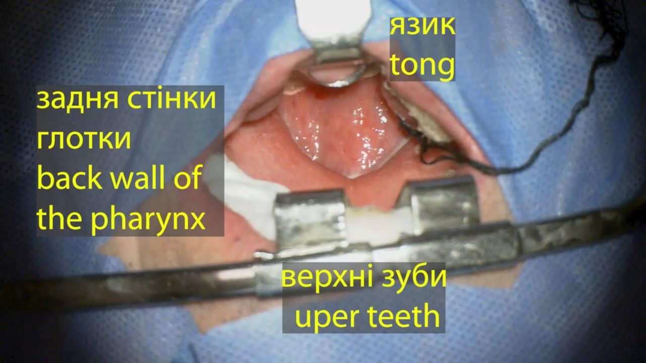 Складний випадок нагноєння хребта 3 Тернопіль