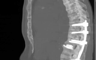 Лікування хвороби Бєхтерева стає досконалішим Лікування хвороби Бєхтерева стає досконалішим