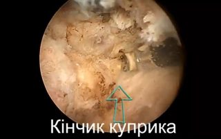 Видалення зламаного куприка у військового Видалення зламаного куприка у військового