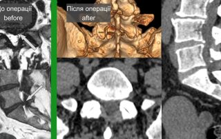 Ендоскопічне видалення грижі диску