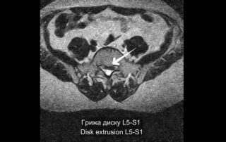 Ендоскопічне видалення грижі диску L5-S1 Ендоскопічне видалення грижі диску L5-S1