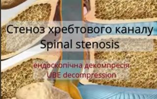 Ендоскопічне лікування стенозу L2–L3 у пацієнтки 75 років (UBE Over-the-Top Decompression)